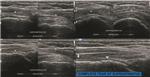 Supraspinatus Tear